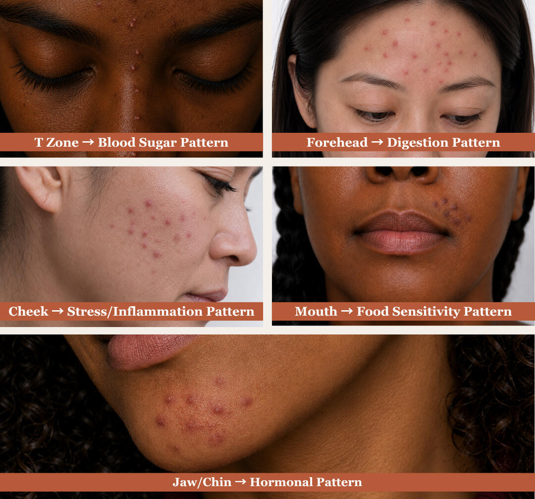 The five acne zones with their internal drivers — Jaw and Chin (Hormonal Pattern), T-Zone (Blood Sugar Patter), Cheek (Stress and Inflammation Pattern), Forehead (Digestion Pattern), Mouth (Food Sensitivity Pattern). A face mapping reference for adult wome